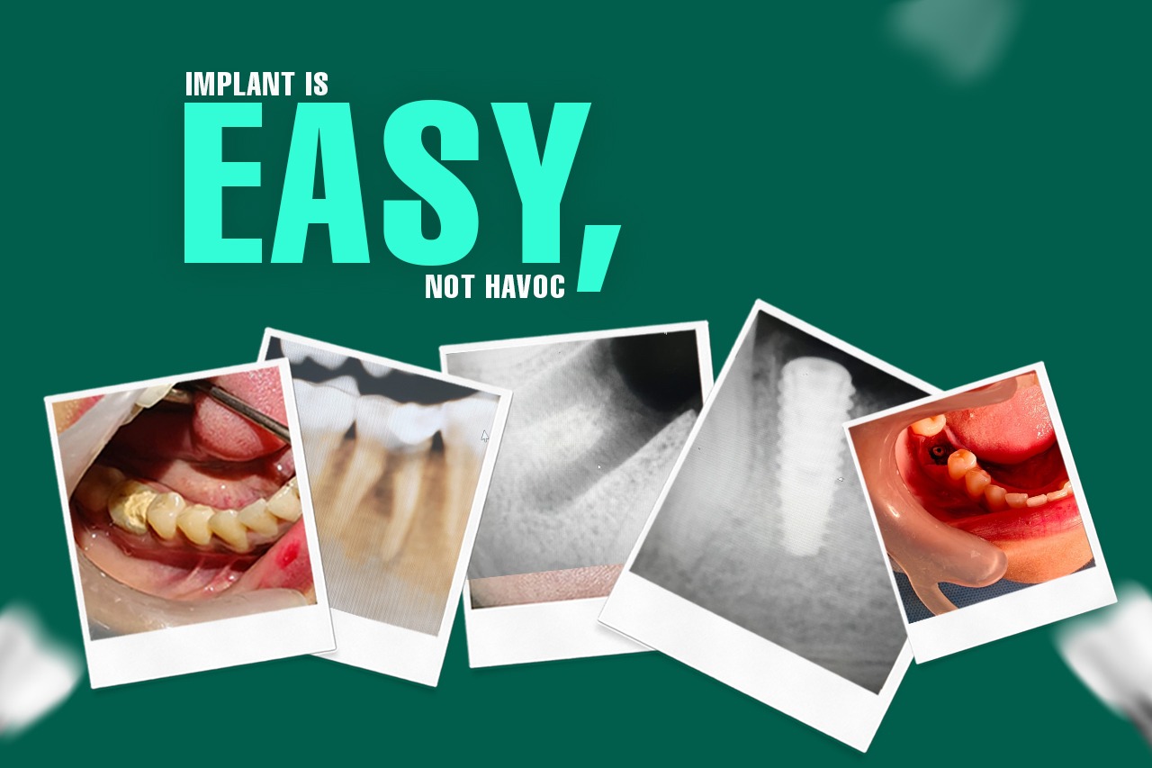 Implant Surgery: A Simple and Smooth Process