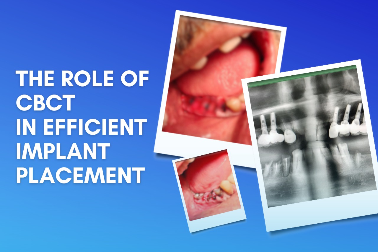 The-Role-of-CBCT-in-Efficient-Implant-Placement