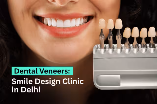 Dental Veneers: Smile Design Clinic in Delhi